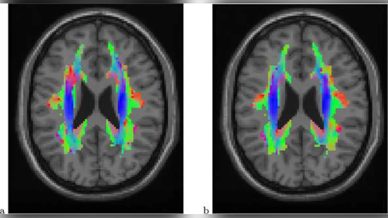 False discovery rate analysis of brain diffusion direction maps