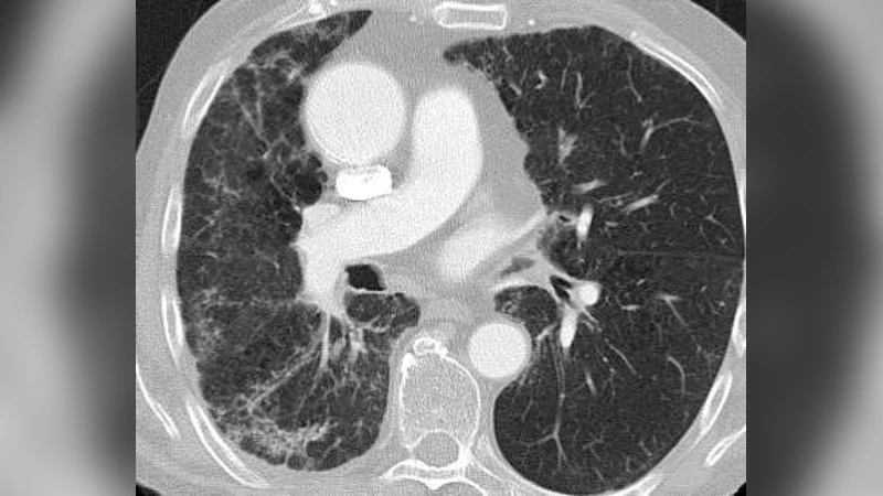 Classification of interstitial lung disease patterns with topological   texture features
