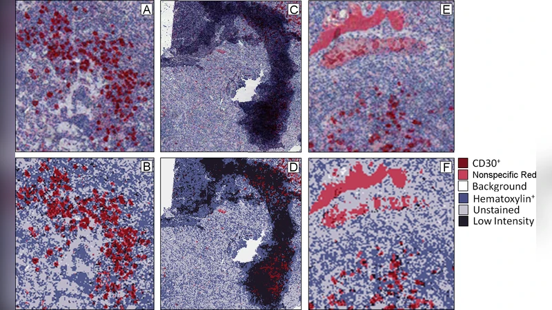 Automated Image Analysis of Hodgkin lymphoma