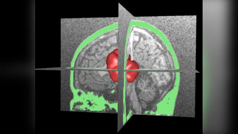 A numerical model for the study of photoacoustic imaging of brain   tumours