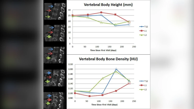 Osteoporotic and Neoplastic Compression Fracture Classification on   Longitudinal CT