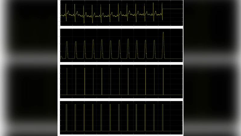 FPGA Implementation of ECG feature extraction using Time domain analysis