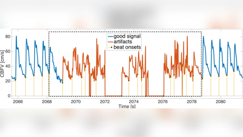 Segmentation of TCD Cerebral Blood Flow Velocity Recordings