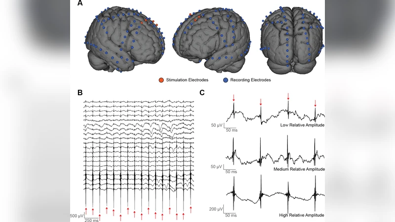 Diffusion geometry approach to efficiently remove electrical stimulation   artifacts in intracranial electroencephalography