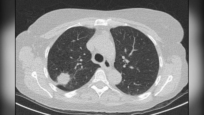 Reduce Noise in Computed Tomography Image using Adaptive Gaussian Filter