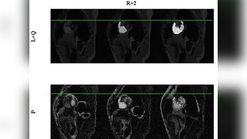Motion correction in cardiac perfusion data by using robust matrix   decomposition