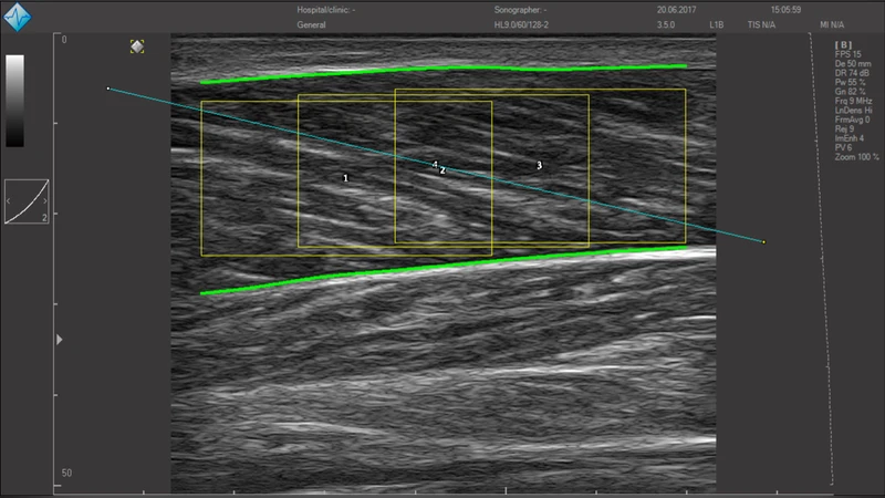 Simple Muscle Architecture Analysis (SMA): an ImageJ macro tool to   automate measurements in B-mode ultrasound scans