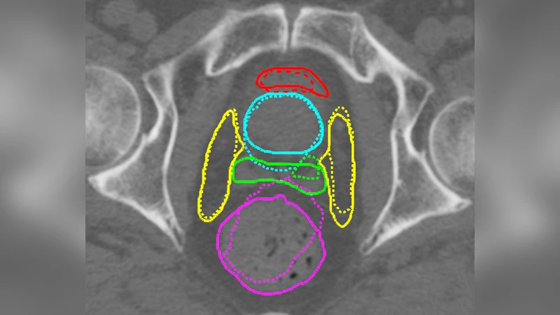 Adversarial optimization for joint registration and segmentation in   prostate CT radiotherapy