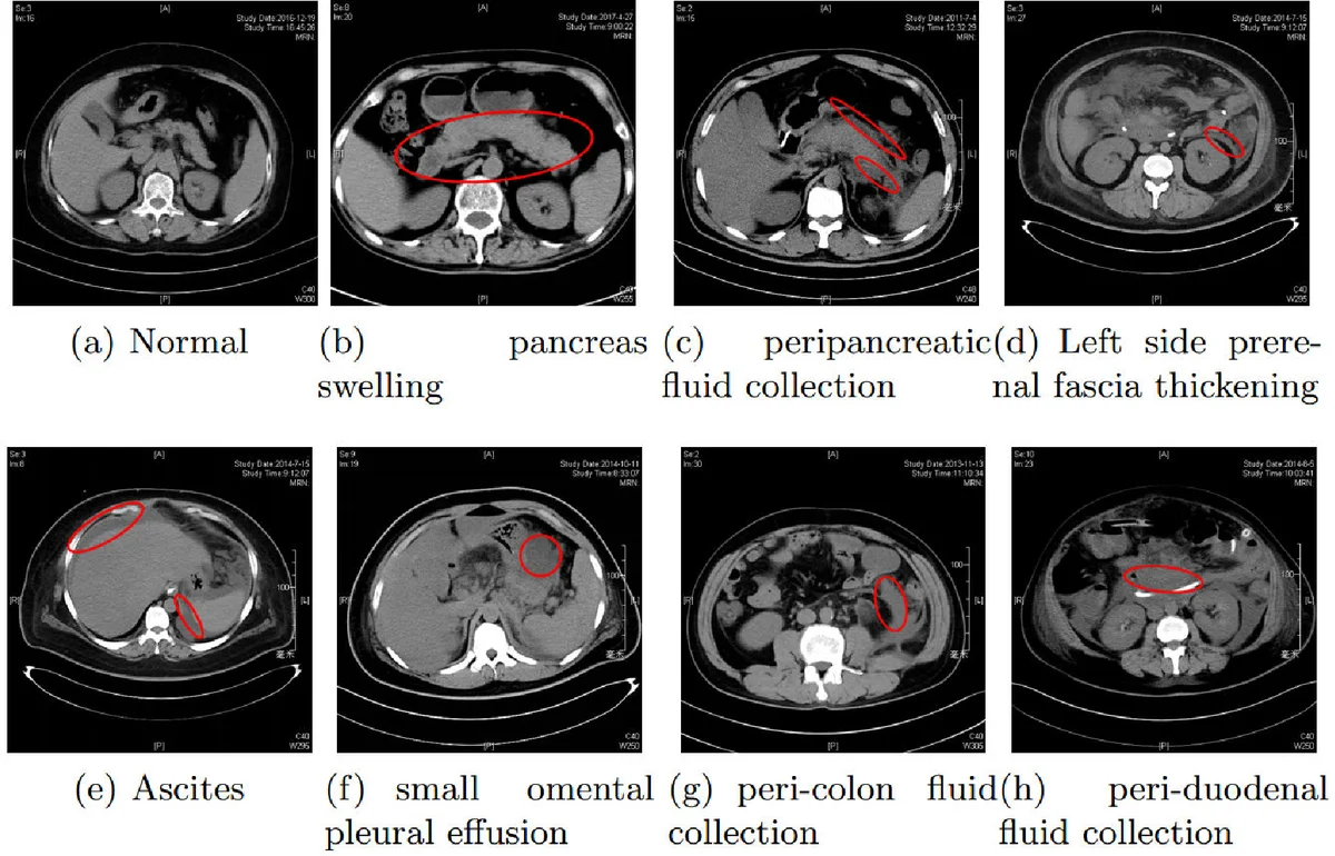 Region-Manipulated Fusion Networks for Pancreatitis Recognition