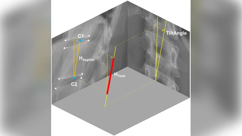 Spinal Compressive Forces in Adolescent Idiopathic Scoliosis With and   Without Carrying Loads: A Musculoskeletal Modeling Study