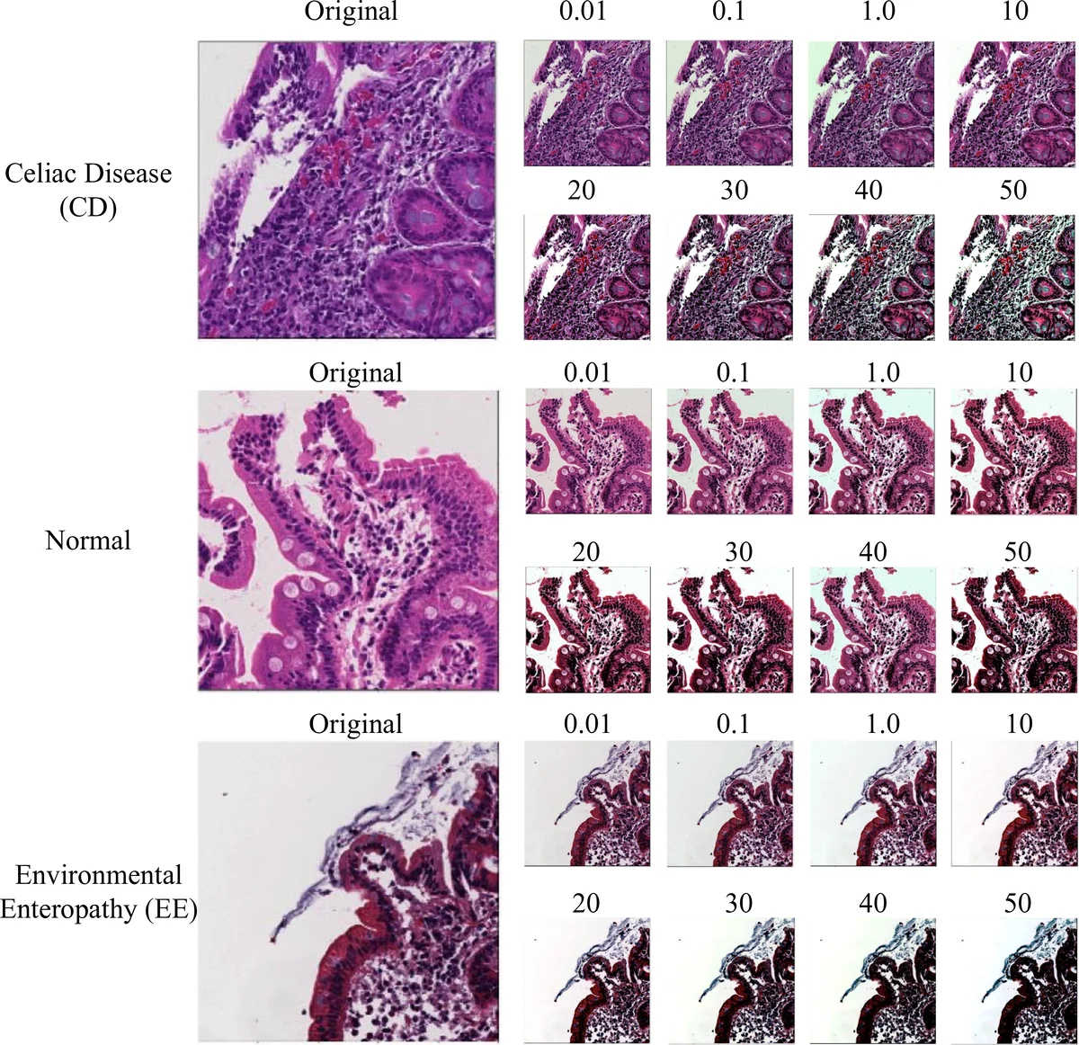 Diagnosis of Celiac Disease and Environmental Enteropathy on Biopsy   Images Using Color Balancing on Convolutional Neural Networks