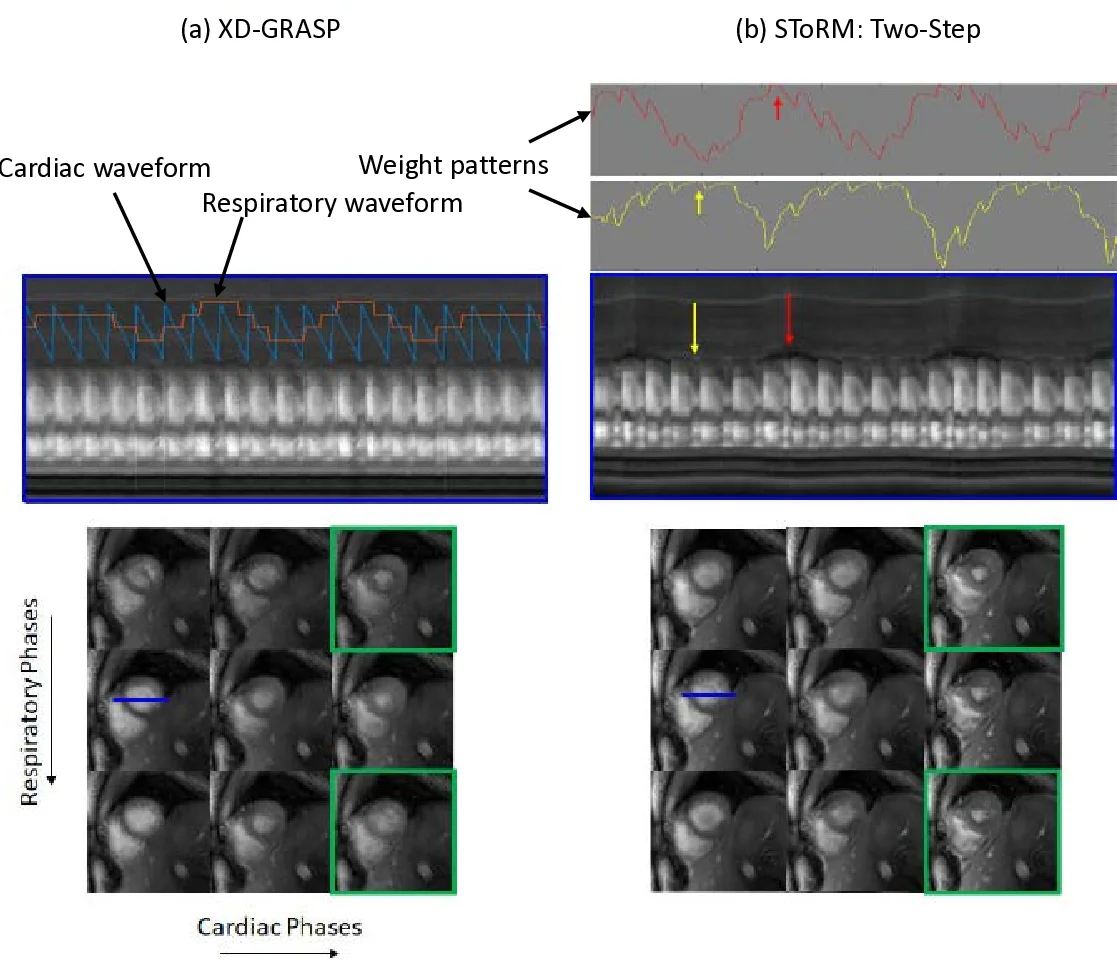 Free-breathing and ungated cardiac cine using navigator-less spiral   SToRM