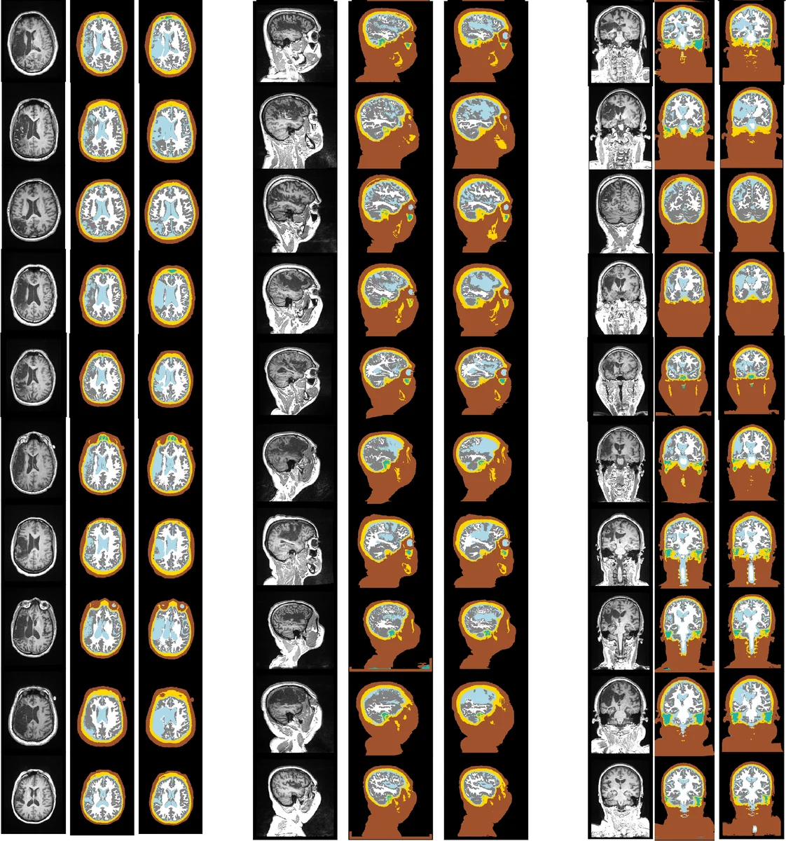 Segmentation of MRI head anatomy using deep volumetric networks and   multiple spatial priors