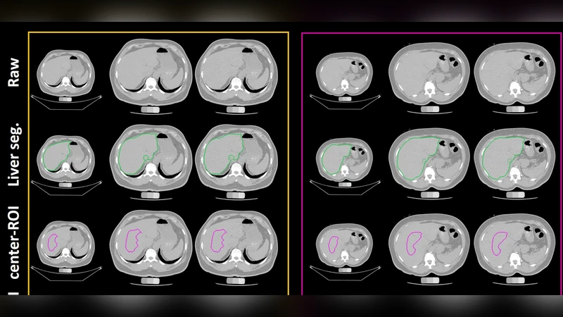 Fully Automatic Liver Attenuation Estimation Combing CNN Segmentation   and Morphological Operations