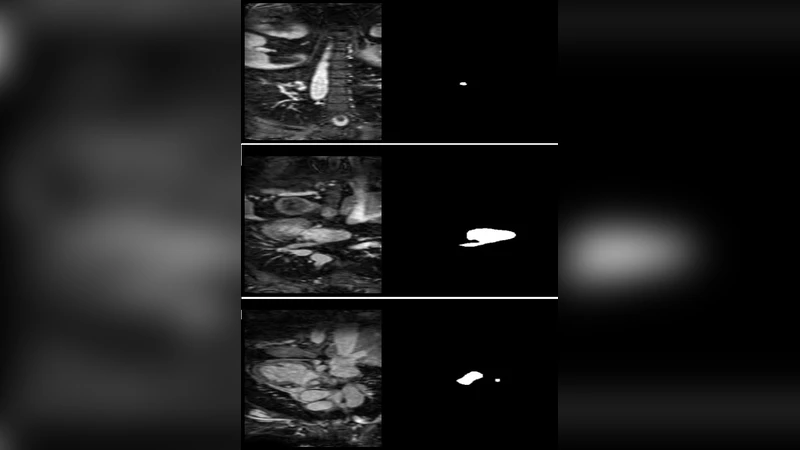 Left Atrial Segmentation with nnU-Net Using MRI