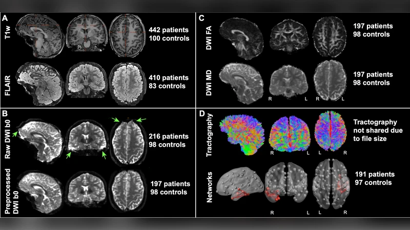 Open diffusion MRI and connectivity data for epilepsy and surgery: The IDEAS II release