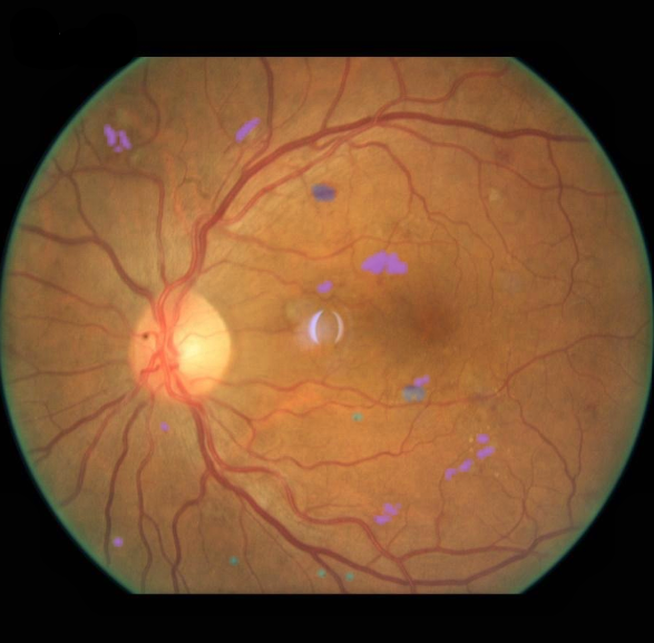 Explainable Fundus Image Curation and Lesion Detection in Diabetic Retinopathy