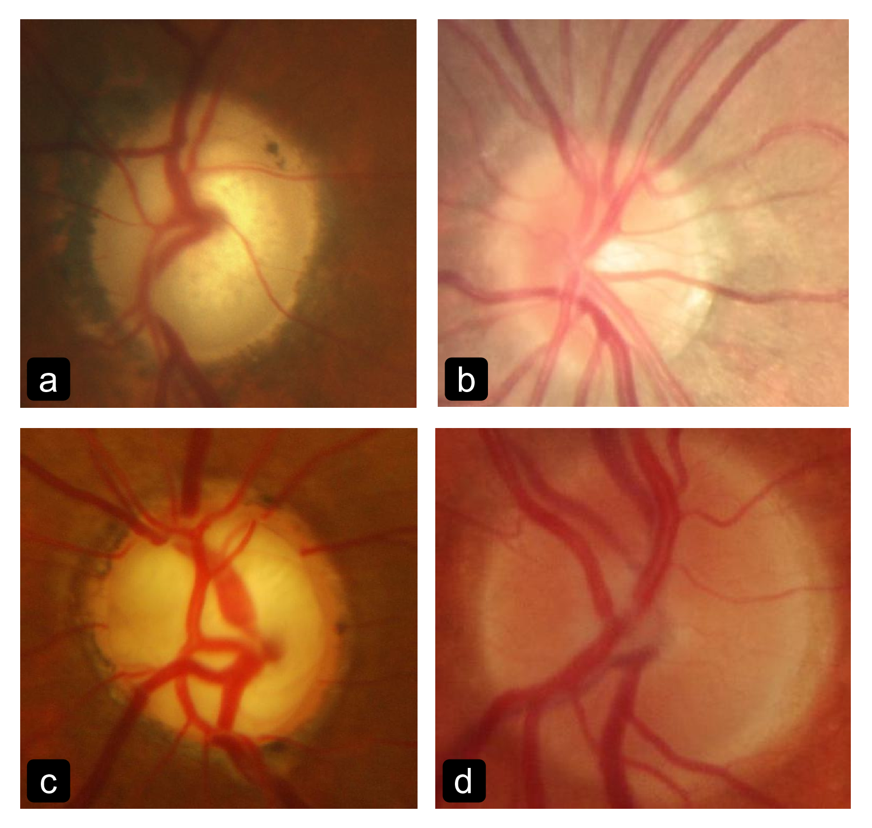 Meta-learners for few-shot weakly-supervised optic disc and cup segmentation on fundus images