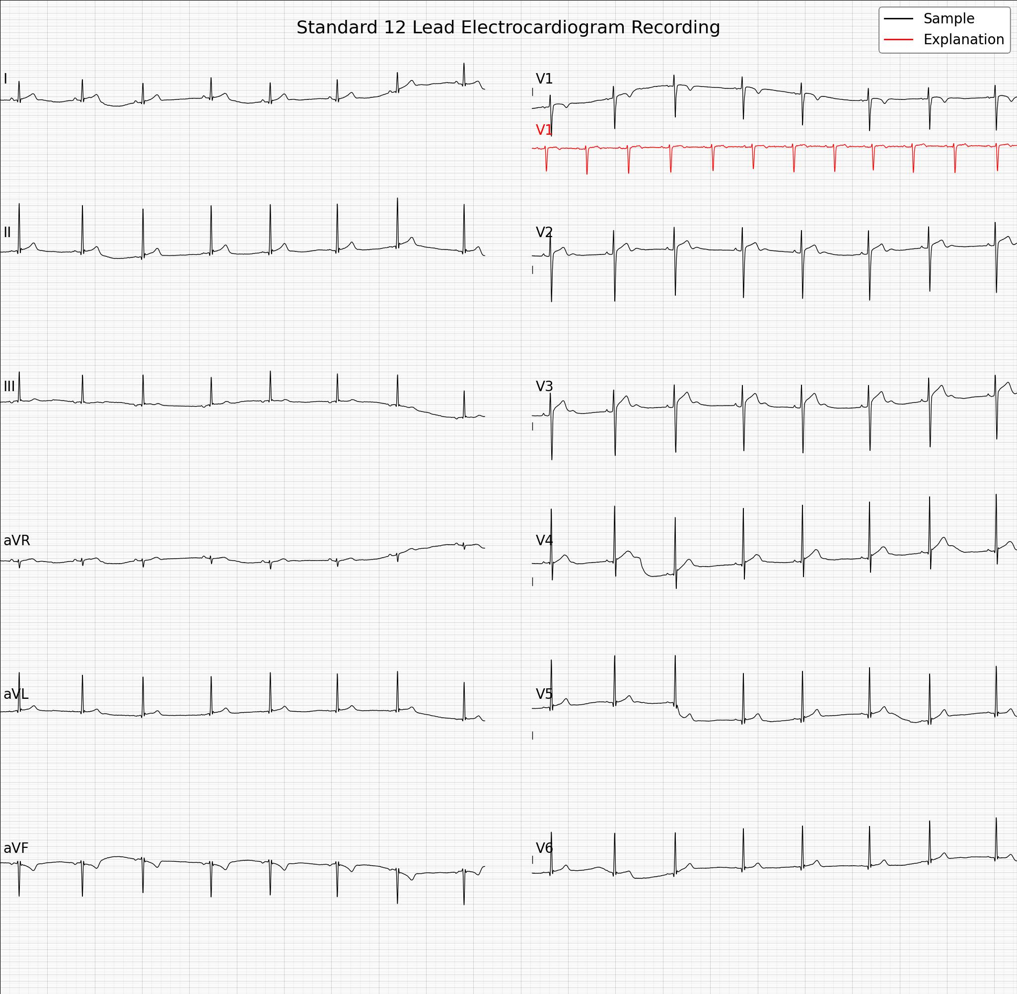ECGCounterfactual_class4_sample40_V4.jpg