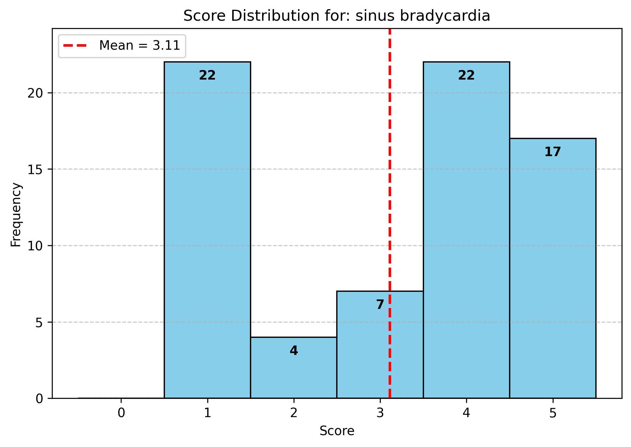 sinus_bradycardiaplot_output.jpg