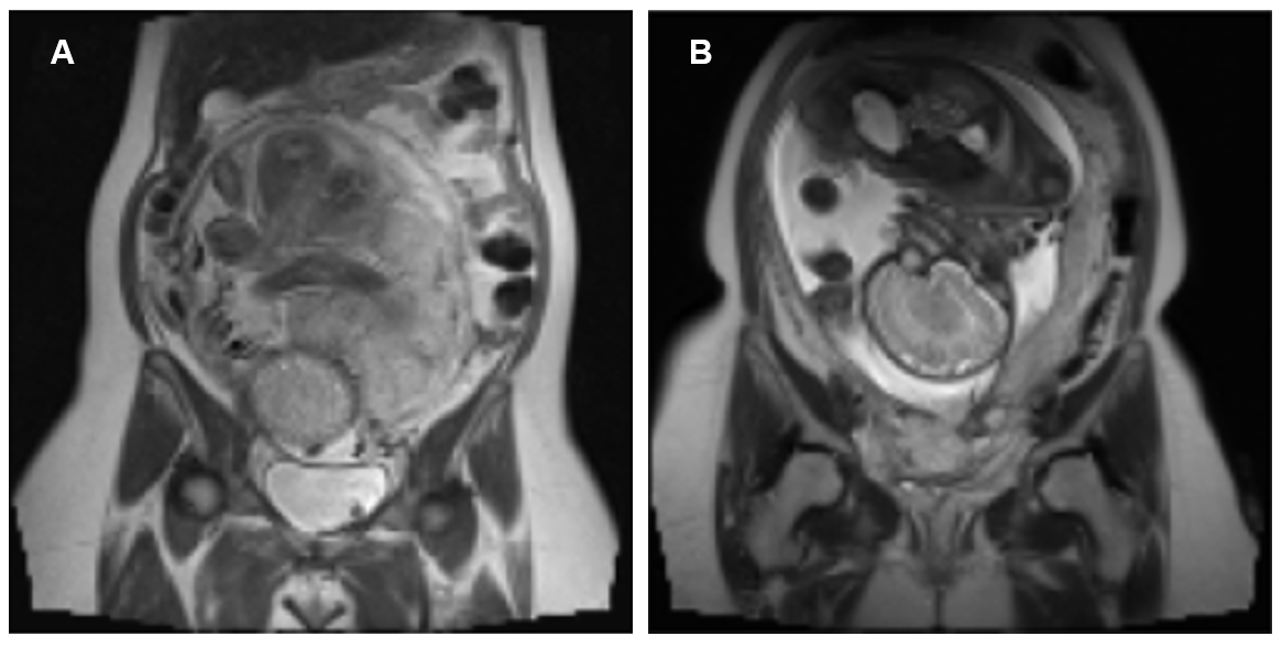 Placenta Accreta Spectrum Detection Using an MRI-based Hybrid CNN-Transformer Model
