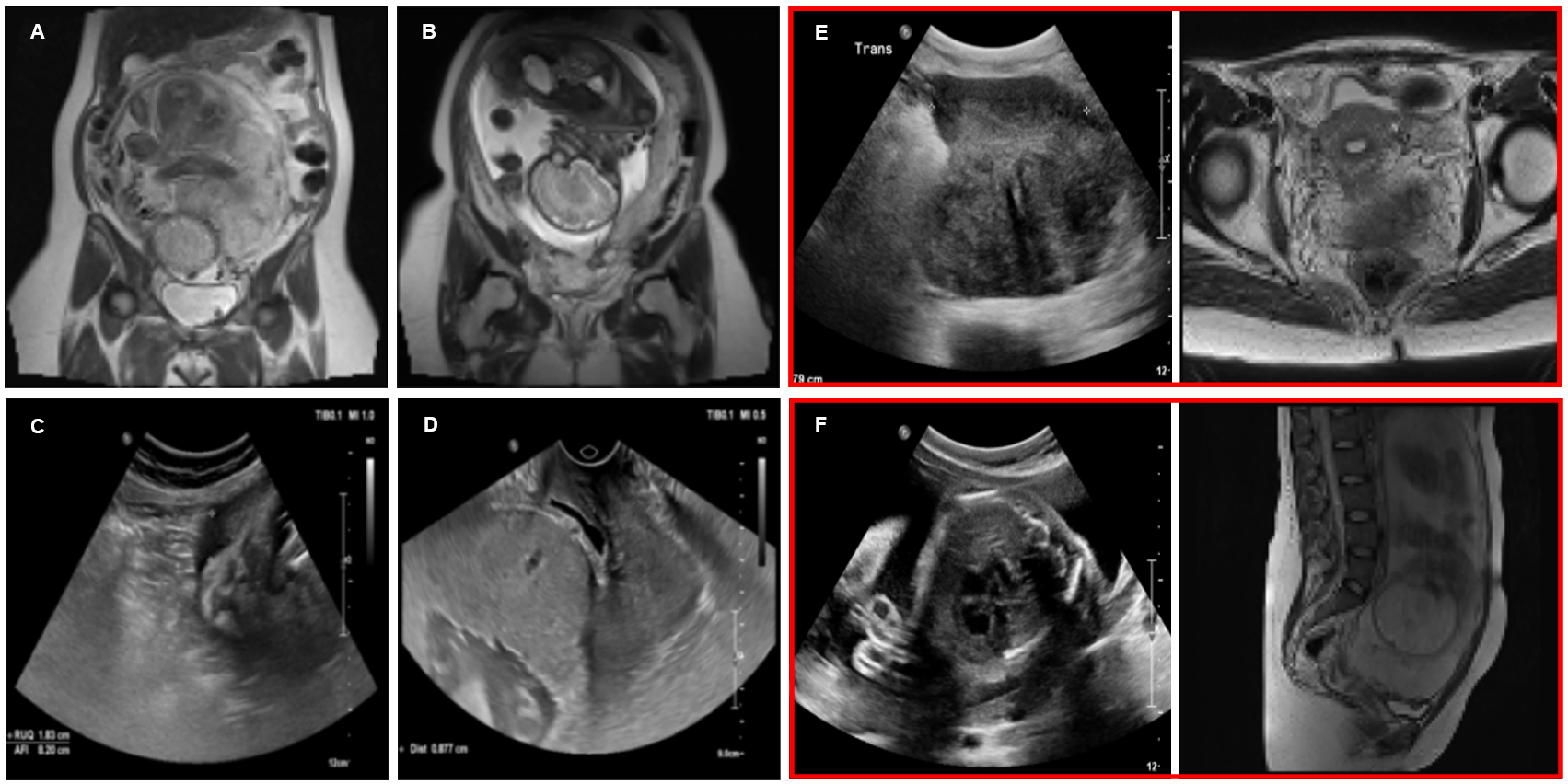Placenta Accreta Spectrum Detection using Multimodal Deep Learning