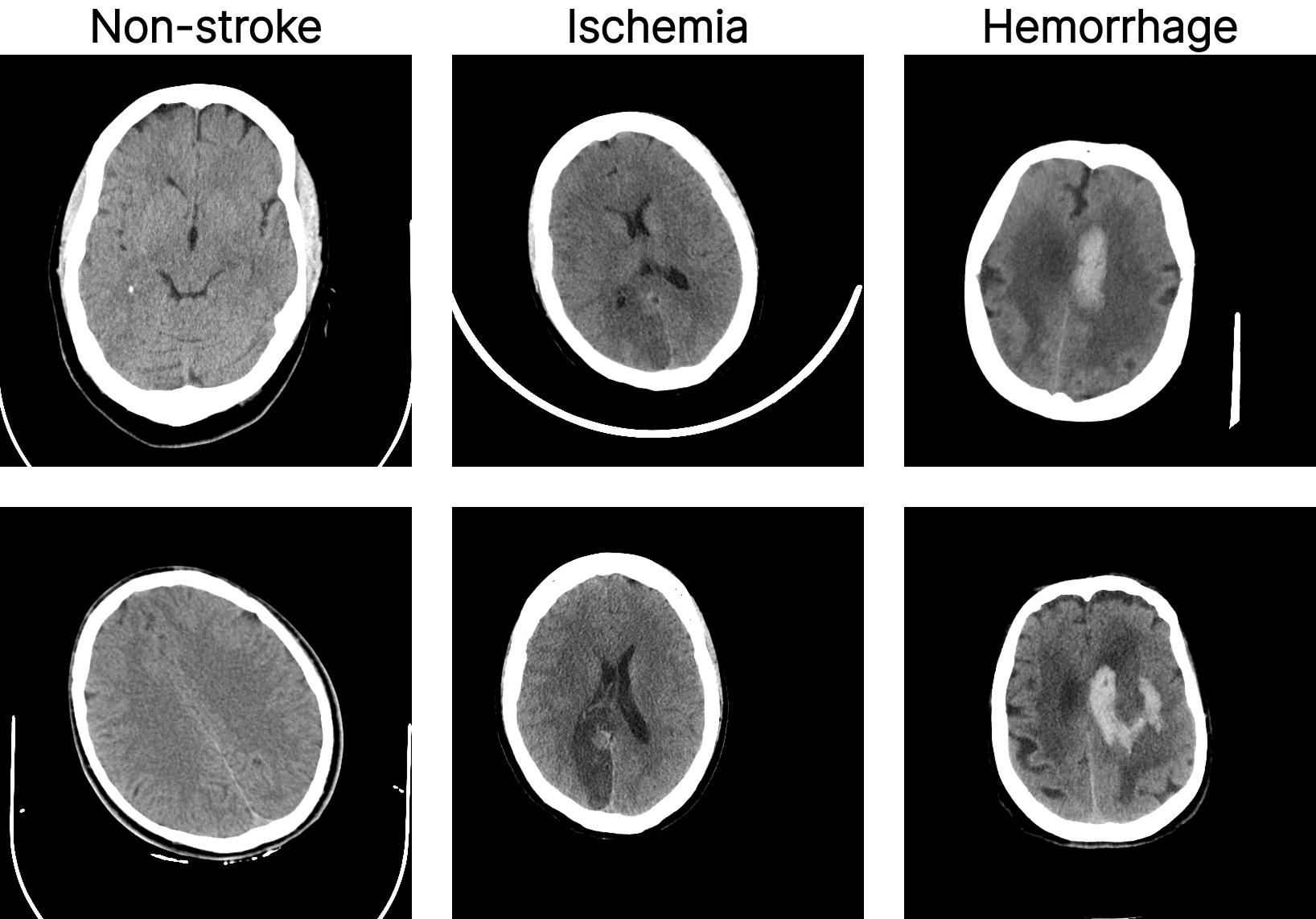 StrokeNeXt: A Siamese-encoder Approach for Brain Stroke Classification in Computed Tomography Imagery