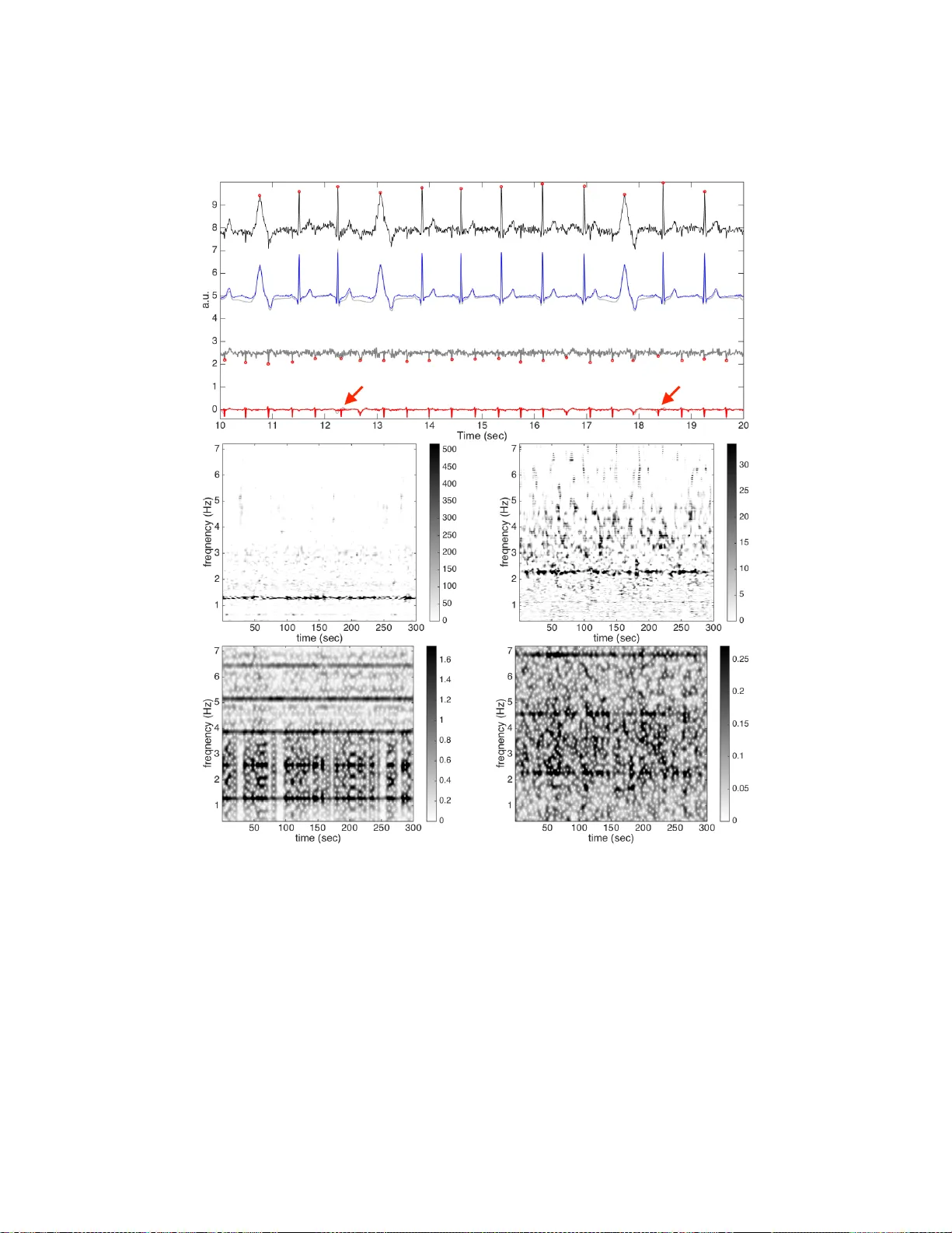 Extract fetal ECG from single-lead abdominal ECG by de-shape short time   Fourier transform and nonlocal median