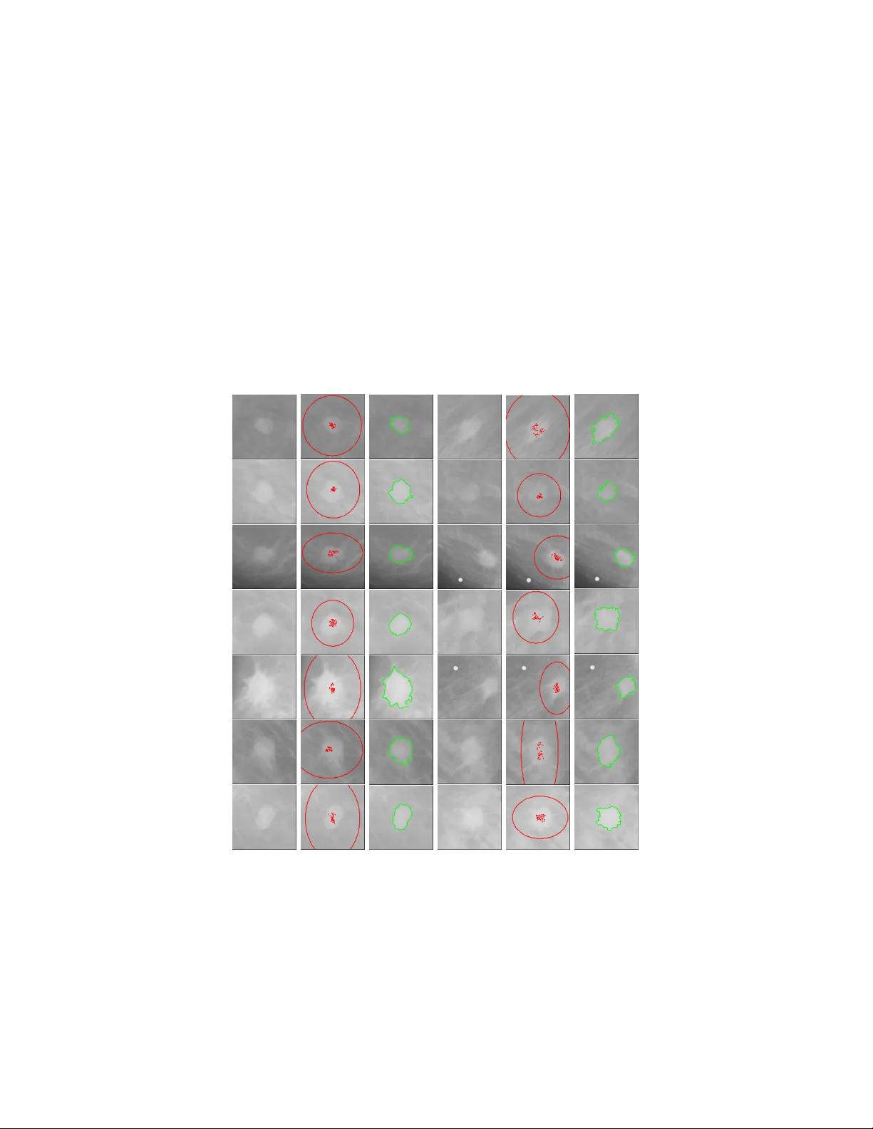 반자동 퍼지 GrowCut 기반 유방 X선 영상 ROI 분할 및 종양 분류