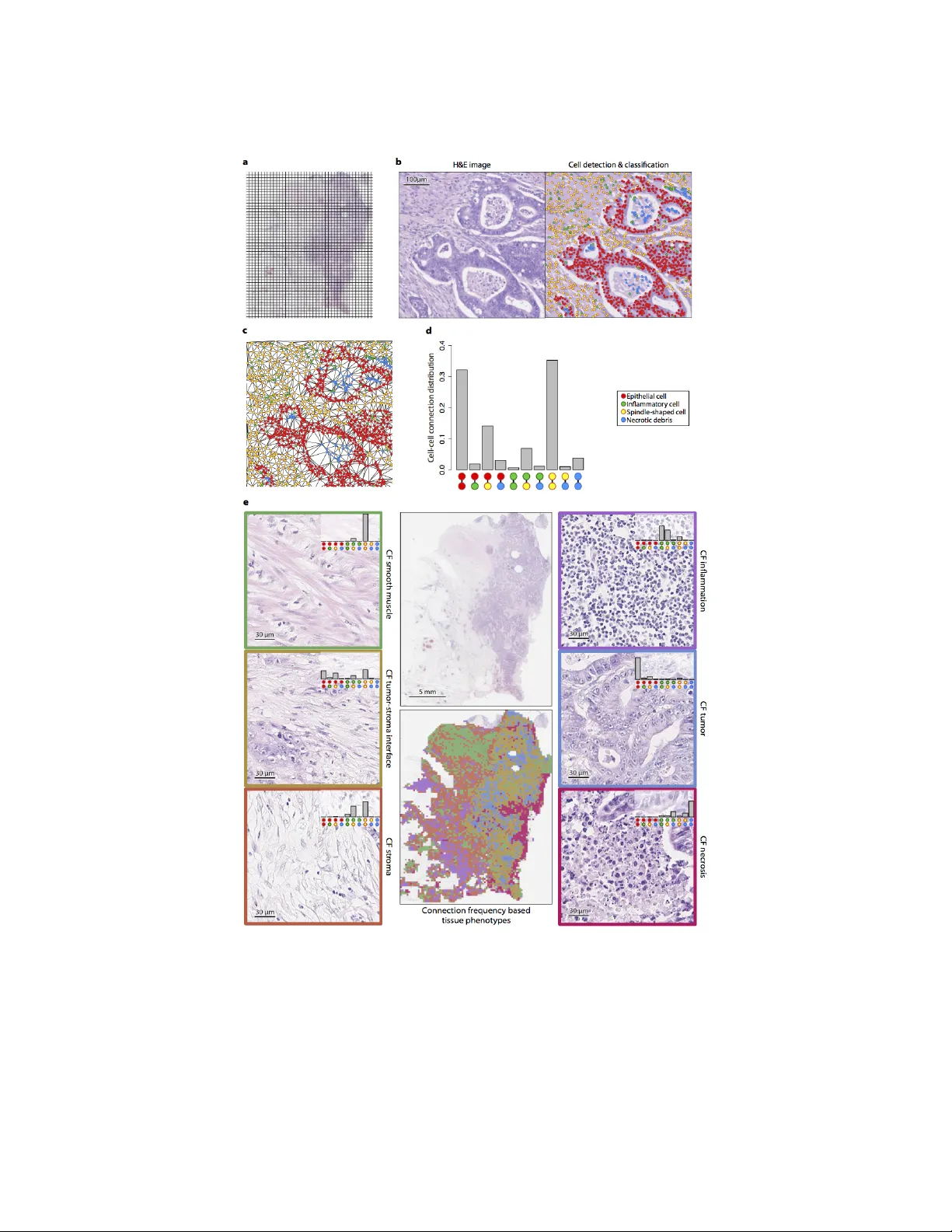 대장암 원격 전이 예측을 위한 디지털 조직 표현형 서명