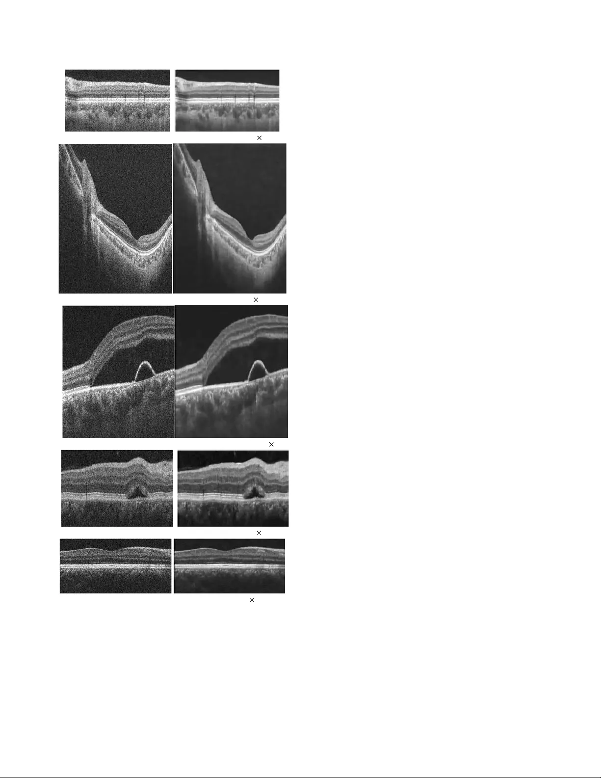 광학코히런스단층촬영 이미지 스페클 제거를 위한 레스넷 기반 범용 방법