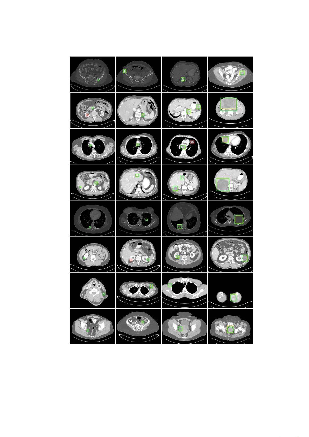 CT 병변 검출을 위한 레티나넷 강화: RECIST 기반 밀집 마스크와 자동 앵커 최적화