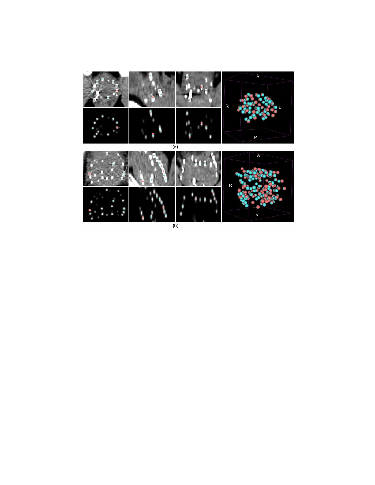프로스테이트 근접치료 시드 자동 식별을 위한 3D 딥 회귀 모델