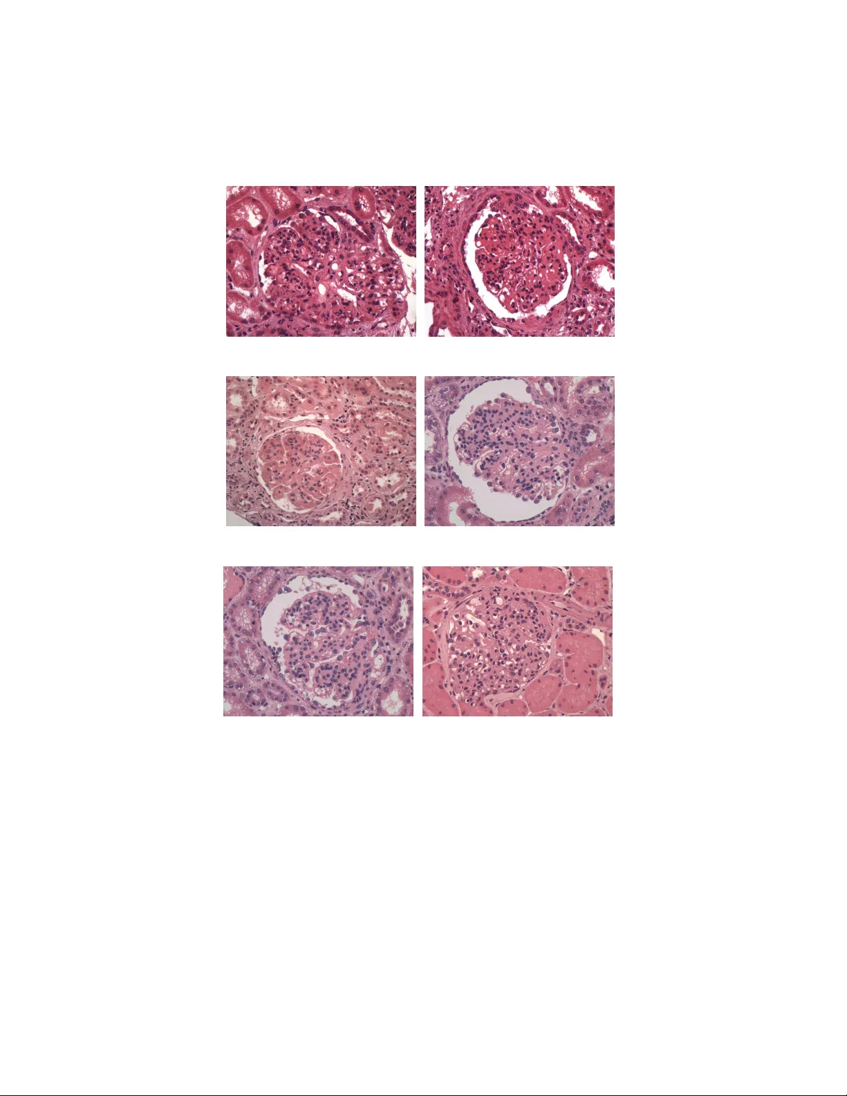 신경망과 서포트벡터머신을 활용한 사구체 과다세포증 자동 분류