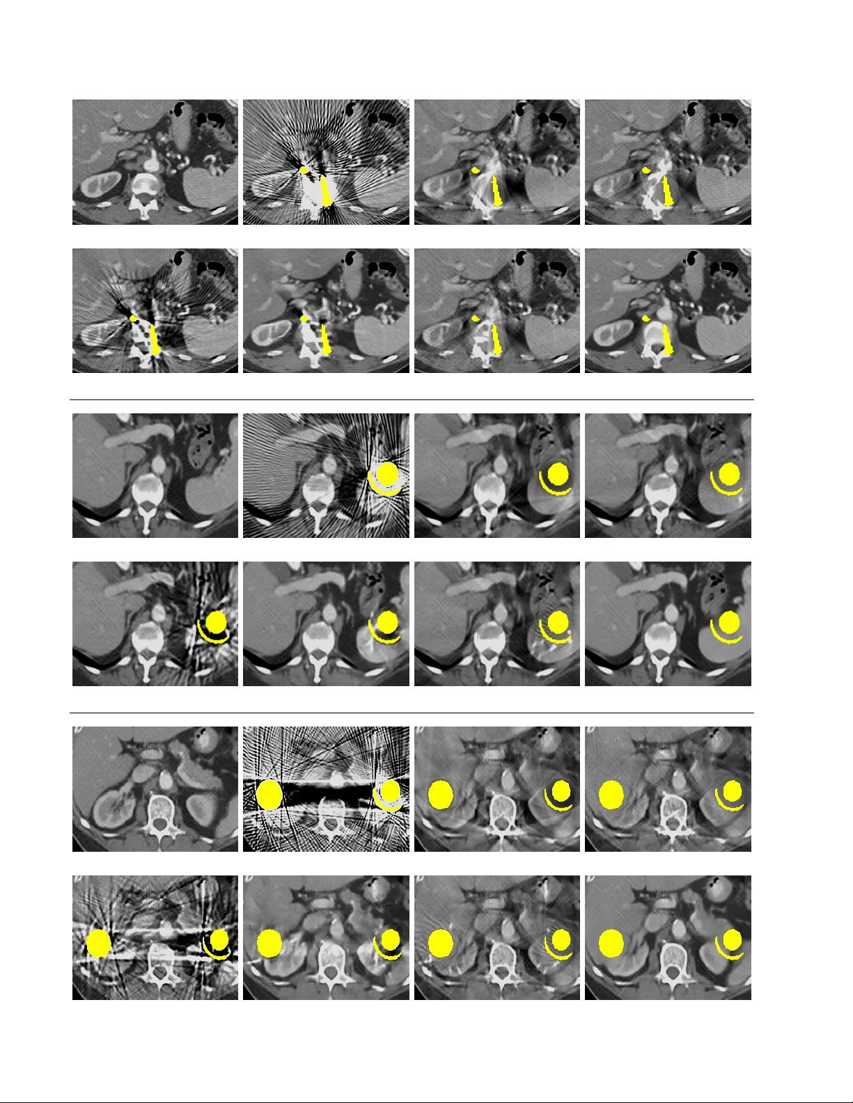 듀얼 도메인 네트워크를 이용한 CT 금속 아티팩트 감소