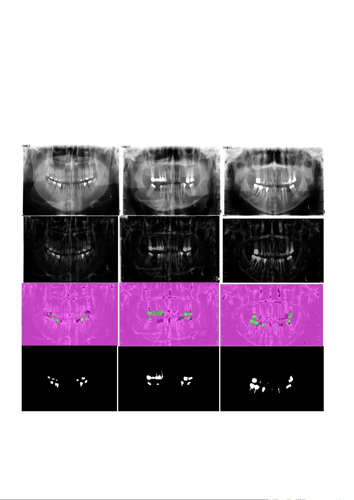 비트플레인 알고리즘을 활용한 치아 충전부 검출 및 면적 정량화