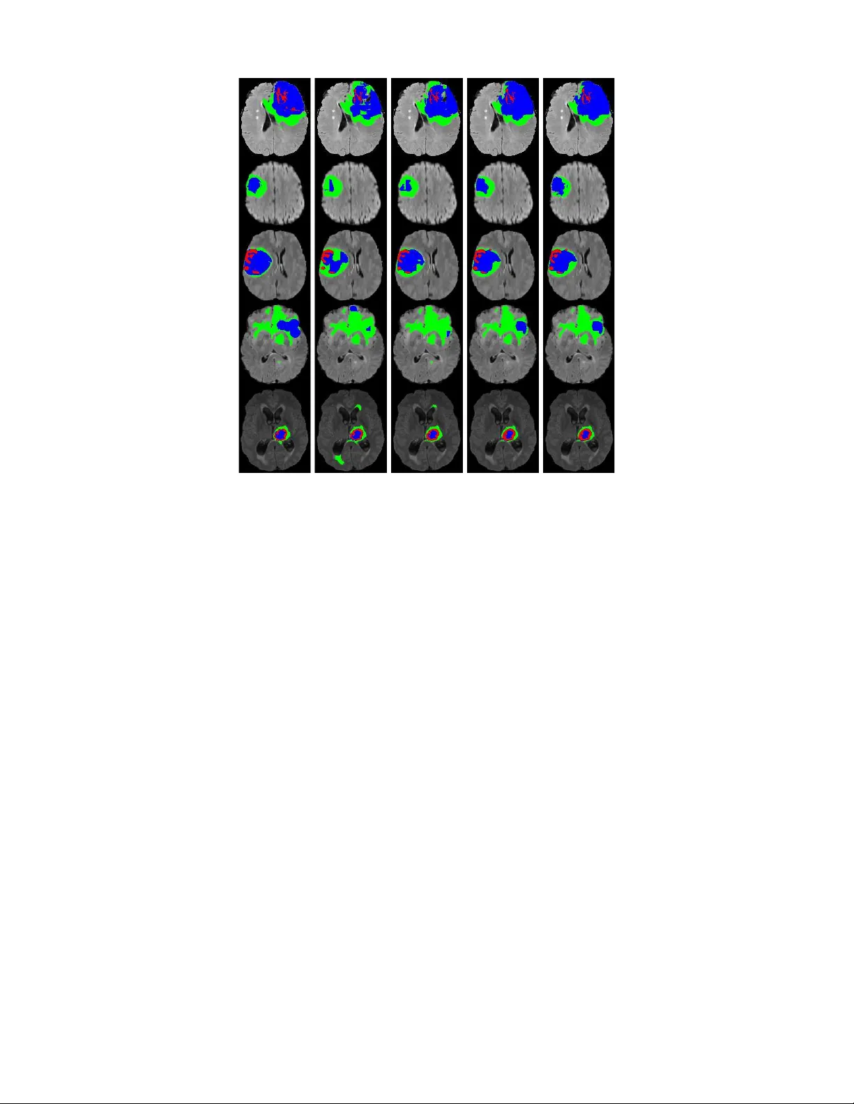 한 번에 끝내는 뇌종양 분할 다중작업 네트워크와 교차작업 주의 메커니즘