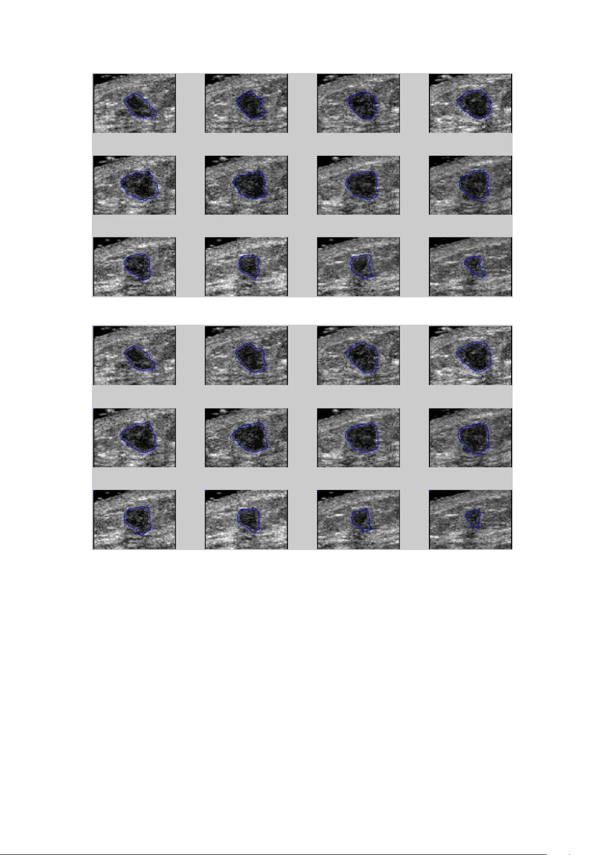 3D 초음파 유방 종양 자동 등고선 추출 방법