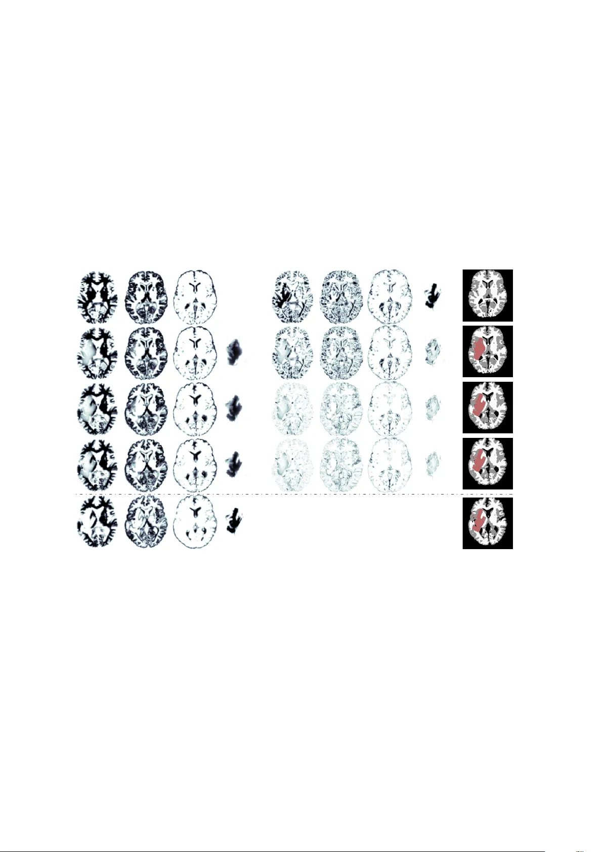 Coupling Brain-Tumor Biophysical Models and Diffeomorphic Image   Registration