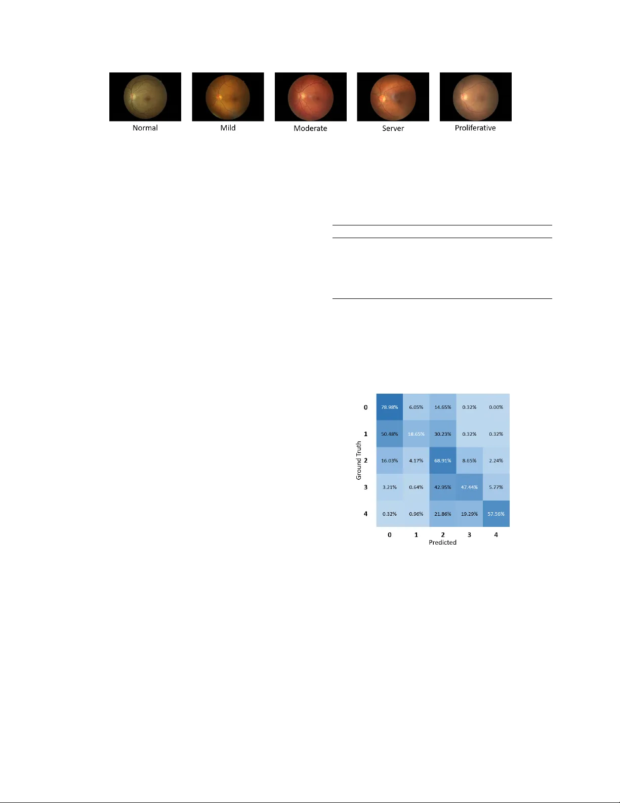 정밀한 당뇨망막증 등급을 위한 이중주의 주의 메커니즘 네트워크