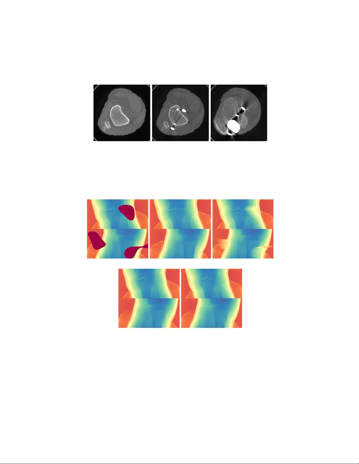 금속 인공물 아티팩트 감소를 위한 생성 마스크 피라미드 네트워크와 투영‑시노그램 공동 보정