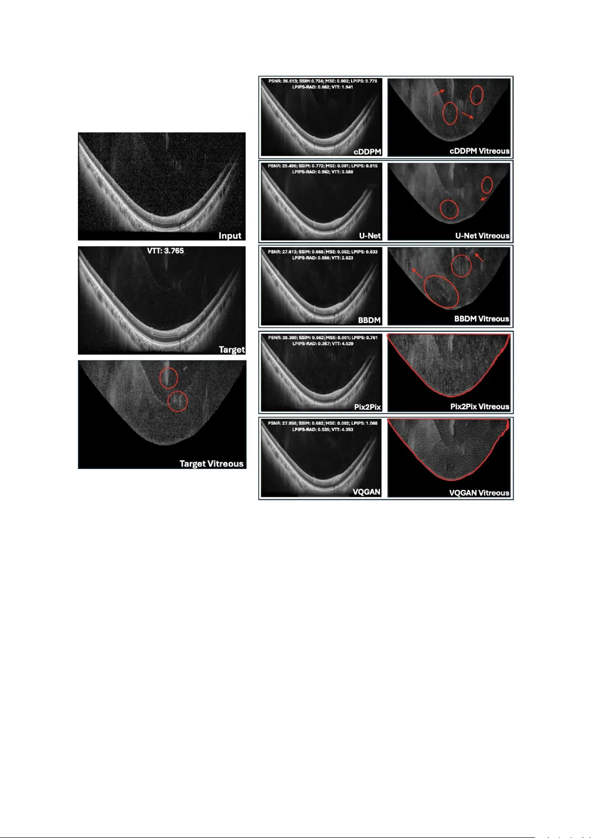 심층 생성 모델을 활용한 고품질 유리체 OCT 영상 향상
