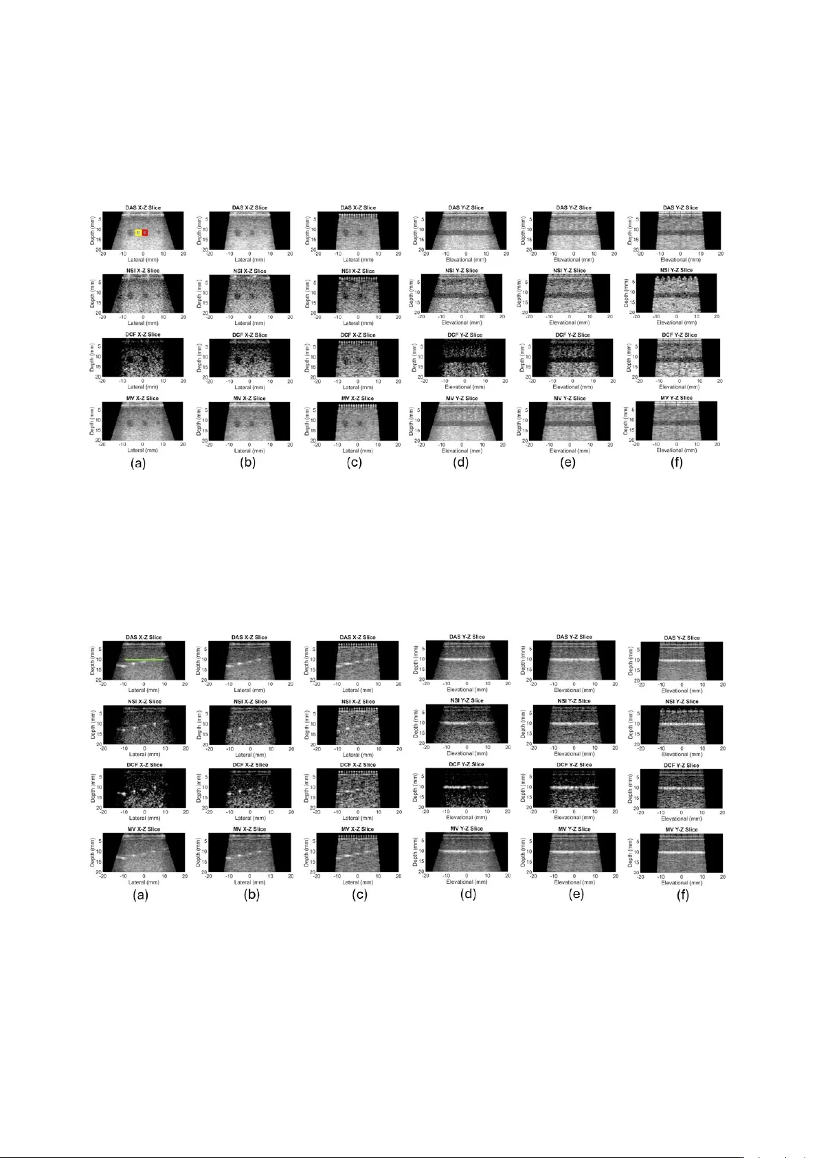 대형 요소와 고급 빔포머로 2D 초음파 매트릭스 어레이 시야 확대
