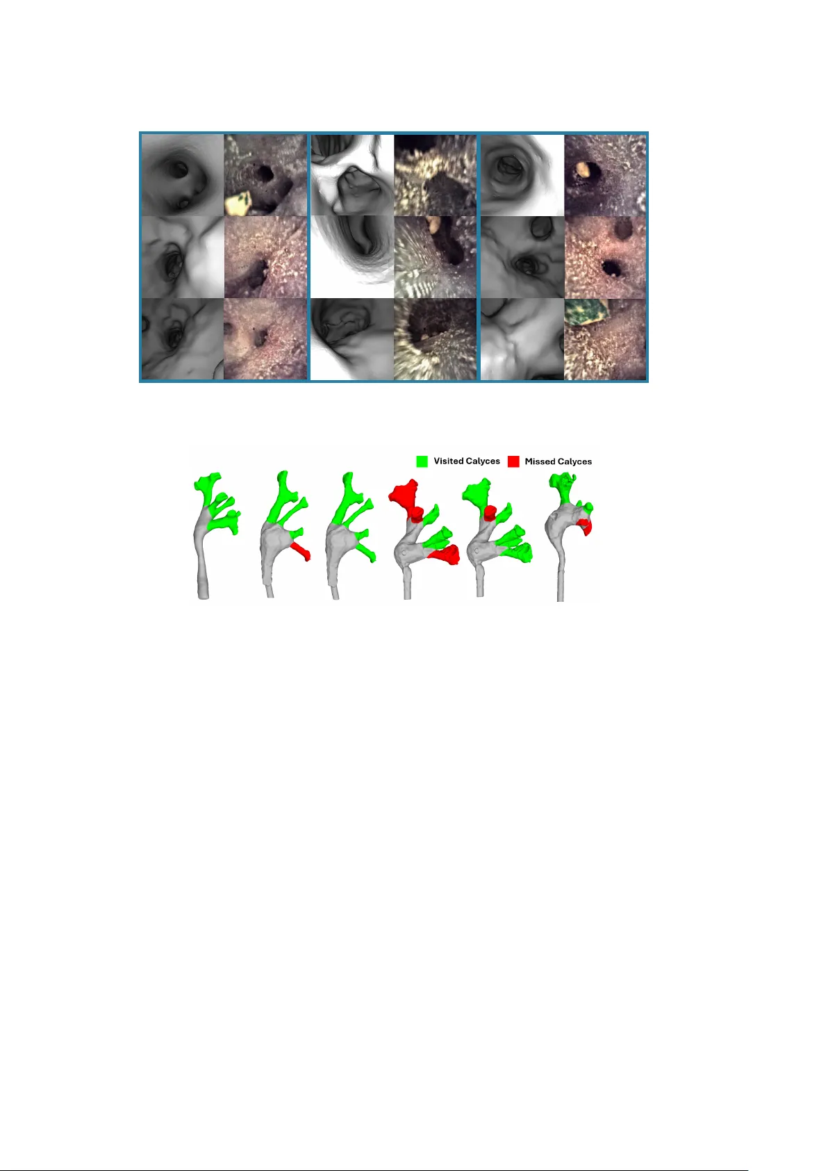 신경망 없는 비디오 기반 신장 내시경 탐색 자동 평가 시스템