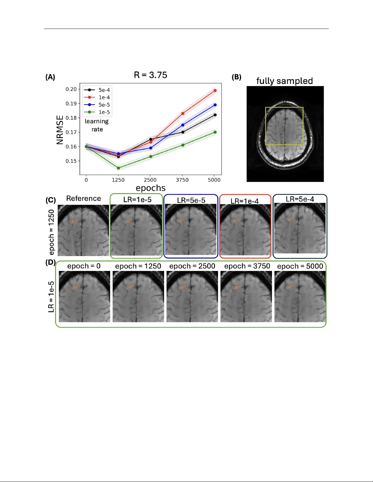 대규모 사전학습과 목표 맞춤 미세조정을 통한 확산 모델 기반 뇌졸중 MRI 가속화