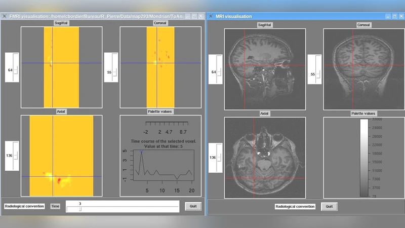 fMRI 데이터 분석을 위한 시공간 ICA와 R 패키지 구현