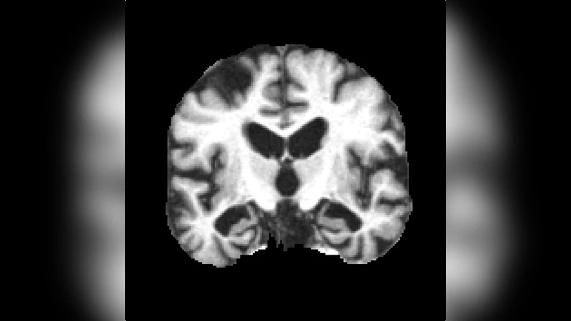 차원 축소 MRI와 SVM을 이용한 치매 분류