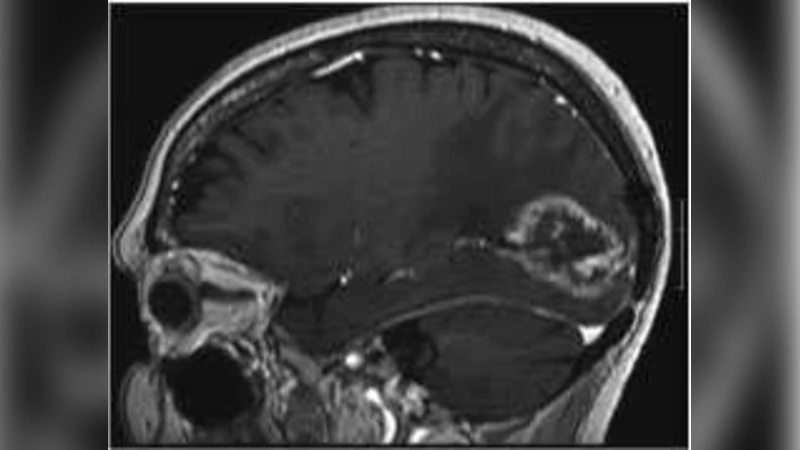악성 교모세포종에서 밝은 고립파