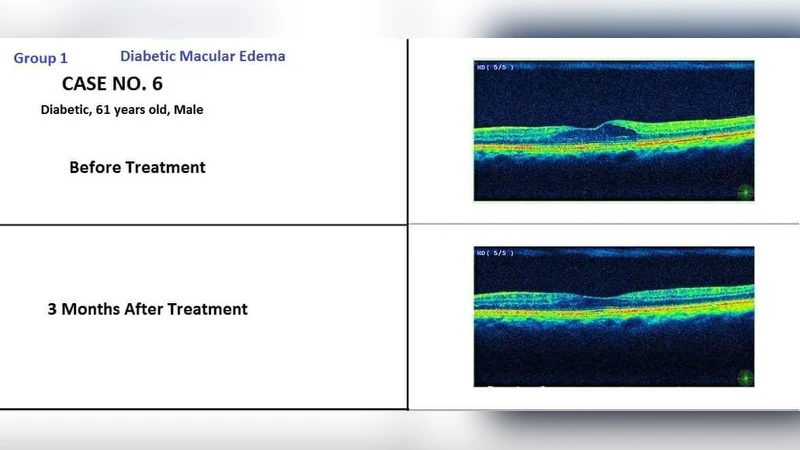 당뇨성 망막증 치료를 위한 경막면 마이크로펄스 다이오드 레이저 기술
