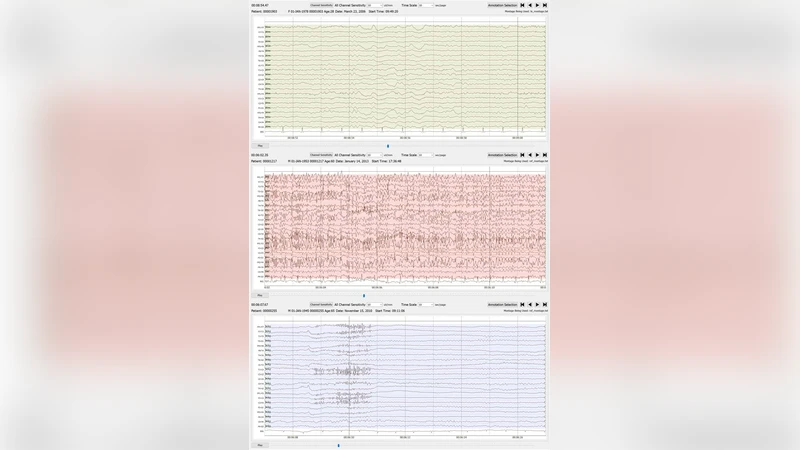 뇌전도 감속 현상, 자동 발작 탐지의 숨은 함정